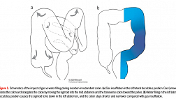 Колоноскопия в анатомически трудном кишечнике: опыт Douglas K. Rex 